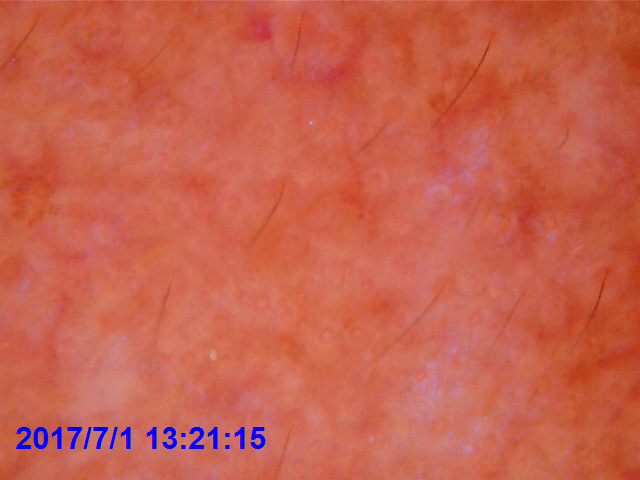 皮肤镜(偏振光)下可见明显的毛细血管扩张及色素沉着 10x