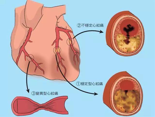 心绞痛一定会痛吗?教你识别心绞痛!