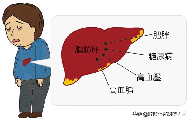 现代富贵病不容忽视的脂肪肝