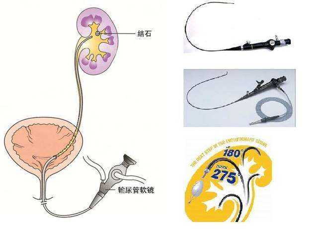 输尿管硬镜的优点是处理输尿管中下段的结石非常好用,并且镜子的