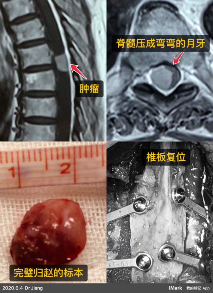 椎管内神经鞘瘤可分为:神经鞘瘤,神经纤维瘤以及恶性末梢神经鞘瘤