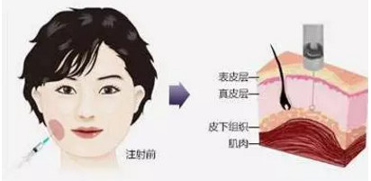 如果自身脸颊比较瘦但咬肌发达,当咬肌瘦下去,也容易导致上述现象的