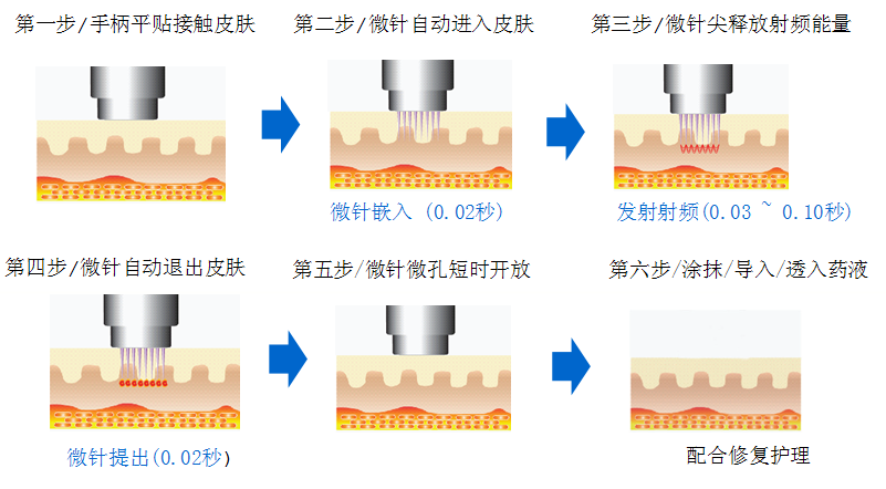 点阵射频是列阵排布射频电极,有非侨腚