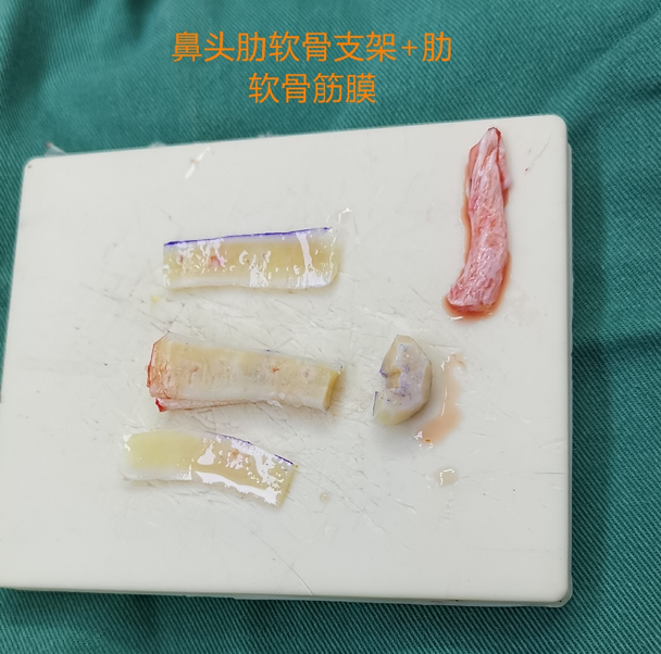 肋软骨筋膜组织
