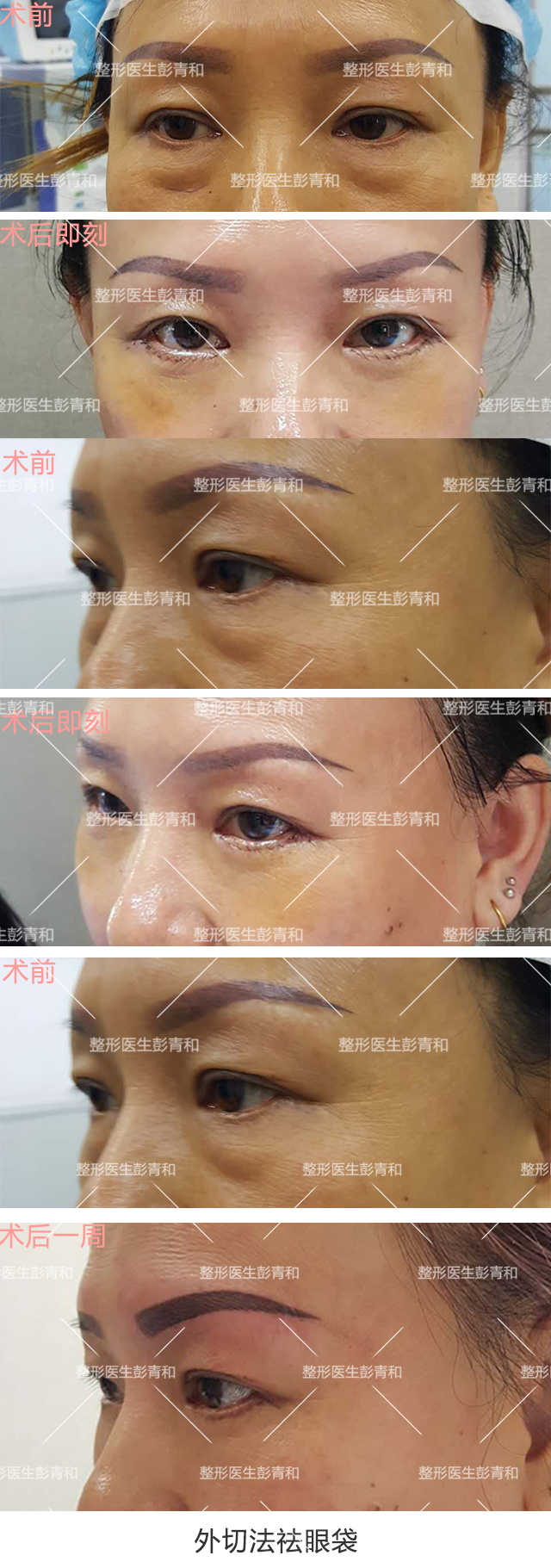 泪沟是凹陷的,它常发起于内眼角,沿下睑缘弧线延长至脸颊部,给人一种