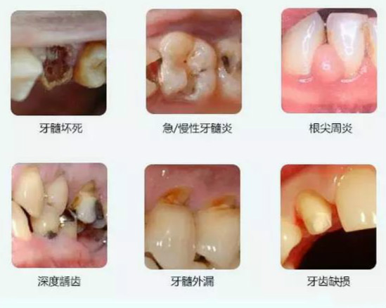 牙髓坏死或坏疽,b.慢性牙髓炎,c.慢性根尖周炎,d.牙髓牙周综合症,e.