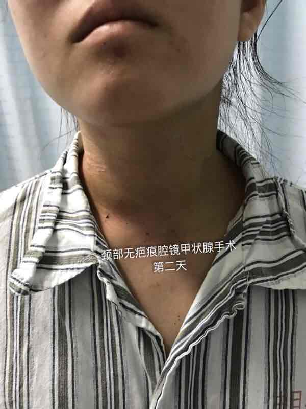 经检查,患者甲状腺结节约5x6厘米大小,她希望做颈部无疤痕腔镜甲状腺