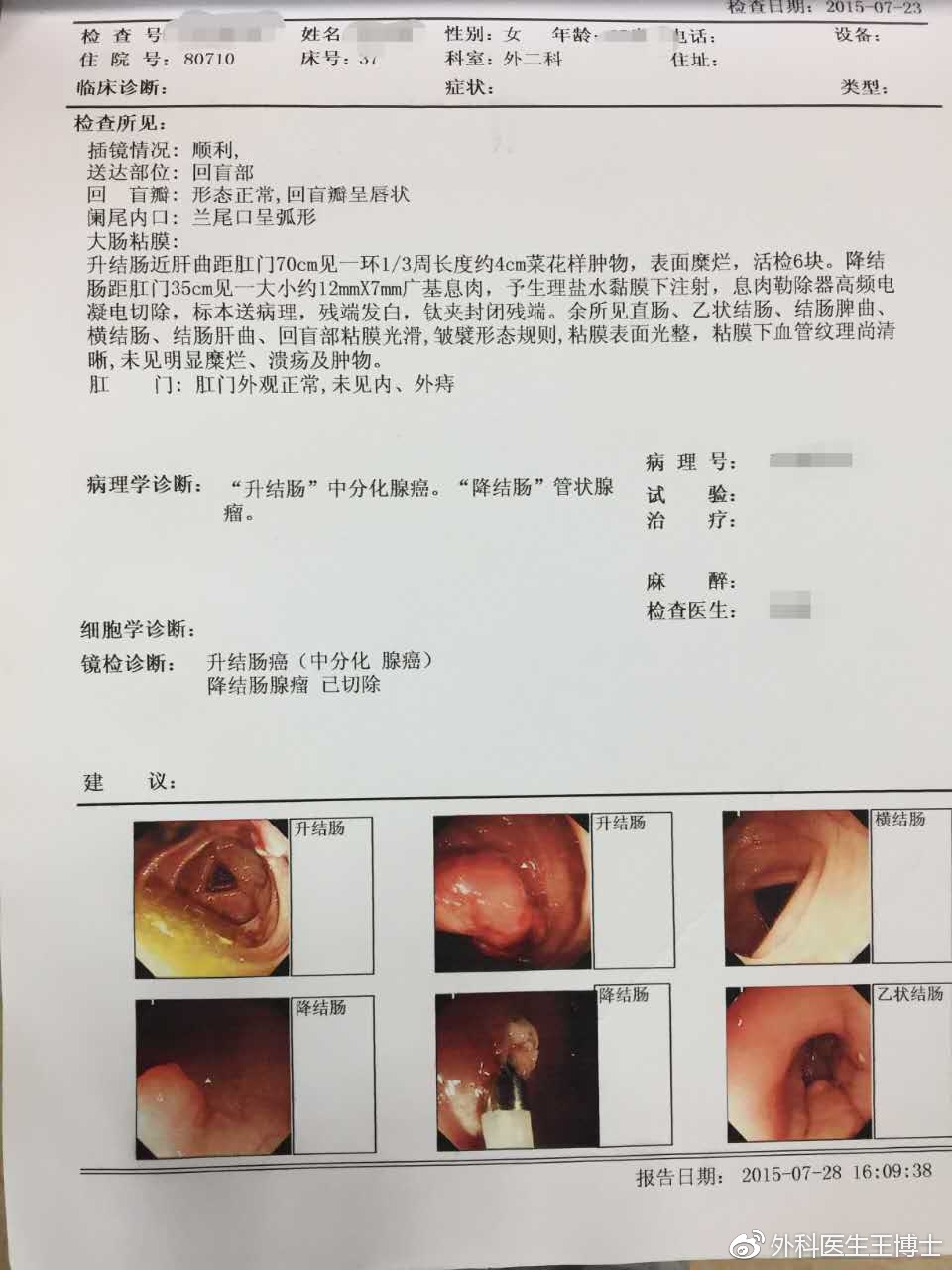 莫要小瞧肠梗阻没准会是结肠癌