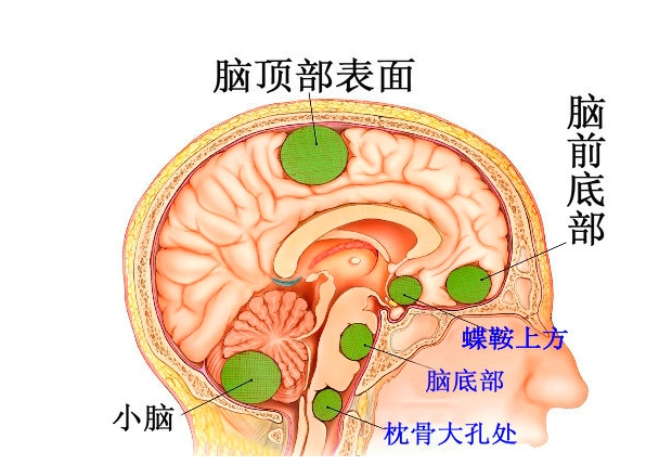 切记要选择多学科联合治疗!特别是恶性的!