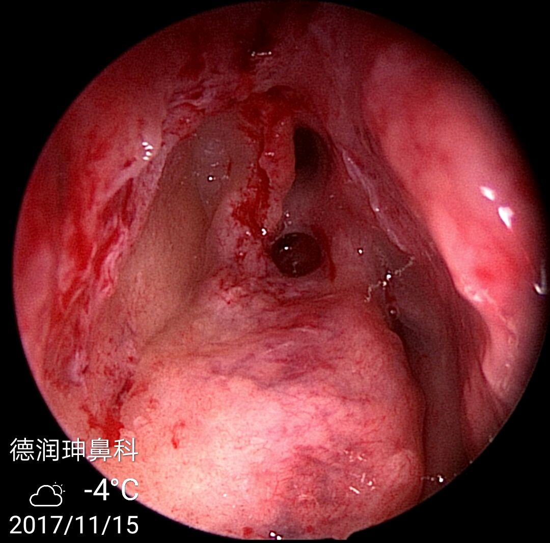 右侧后鼻孔息肉源于右侧钩突粘膜.息肉上有很多小潴留囊肿形成.