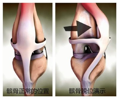 当心习惯性髌骨脱位惹得祸