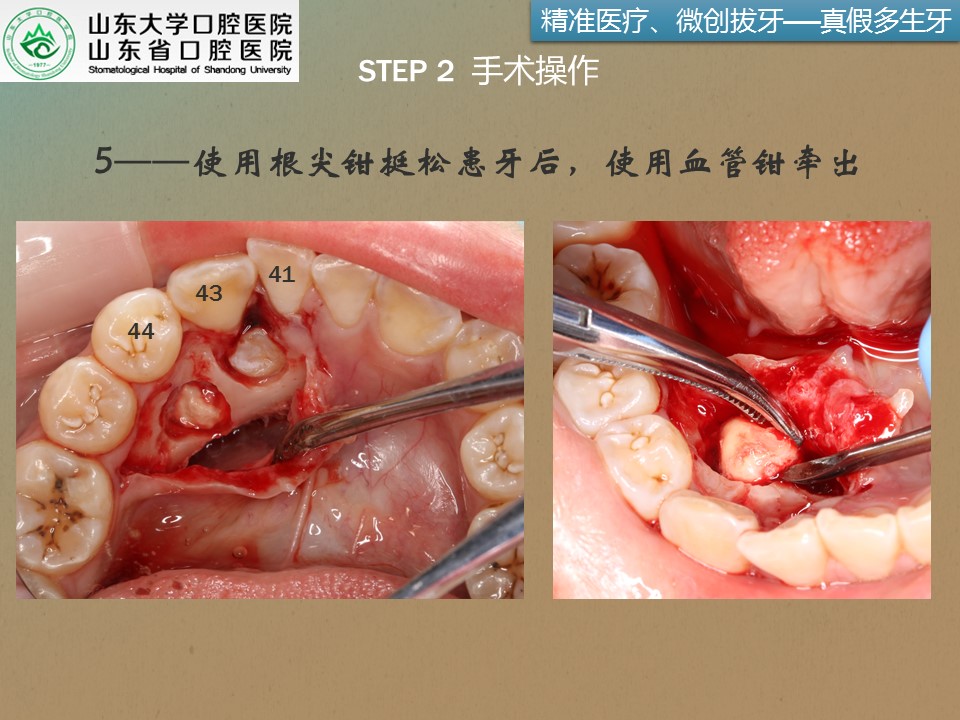 疑难复杂牙拔除系列3右下颌前磨牙根方两颗多生牙