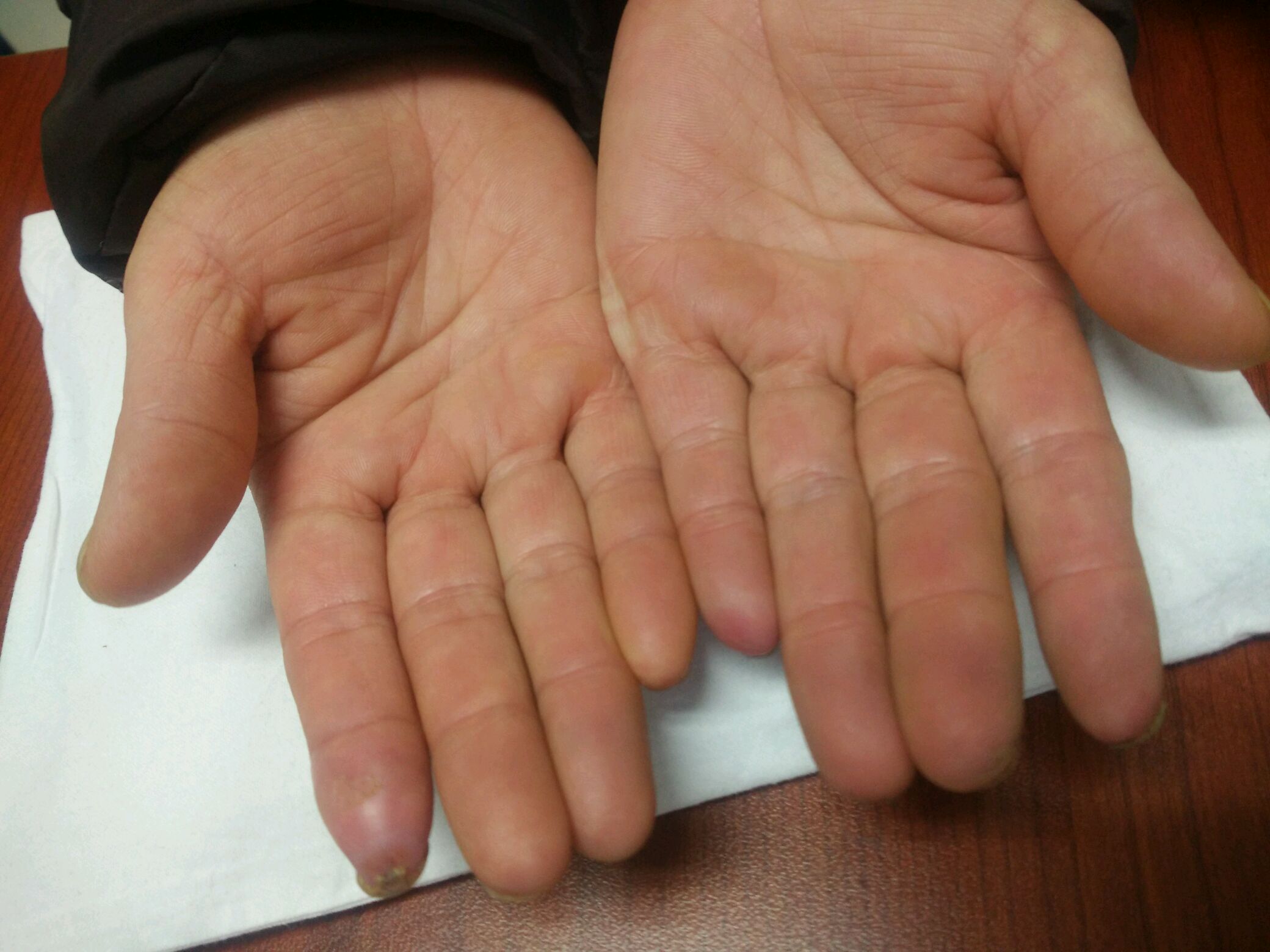 冰冷的手:雷诺氏病|自身免疫疾病文章|身体和健康条件中心| SteadyHealth.com - 华体会全站app网址
