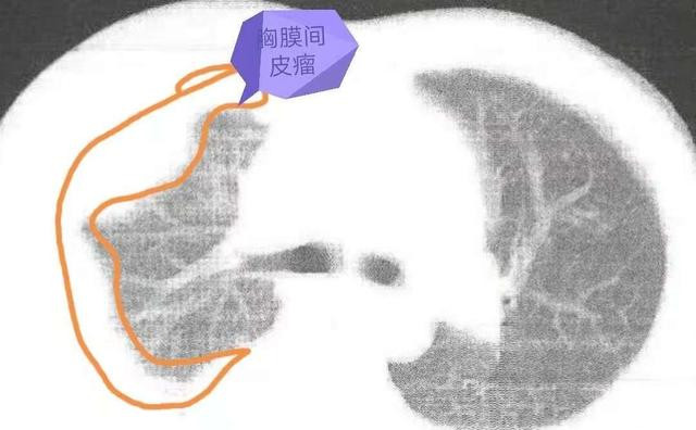 又一个痛心的案例原本治疗效果好的胸膜间皮瘤患者没办法了