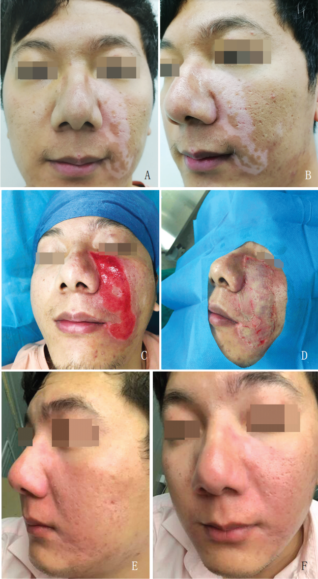 皮肤磨削术及其临床应用