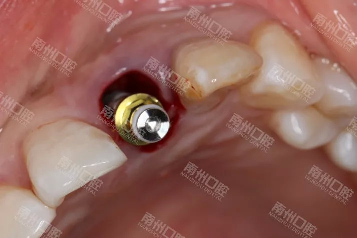门牙折断,种植牙修复案例分享