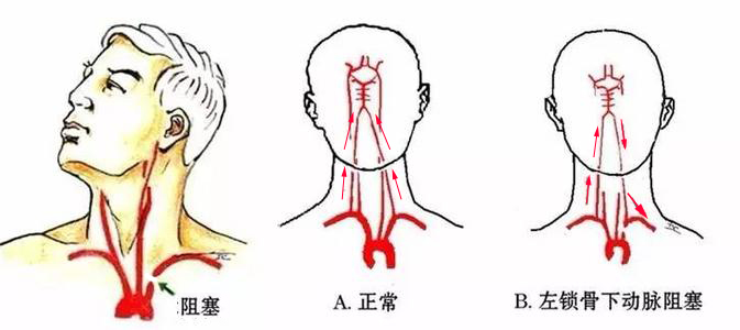 锁骨下动脉闭塞如何治疗-张义森主治医师-爱问医生