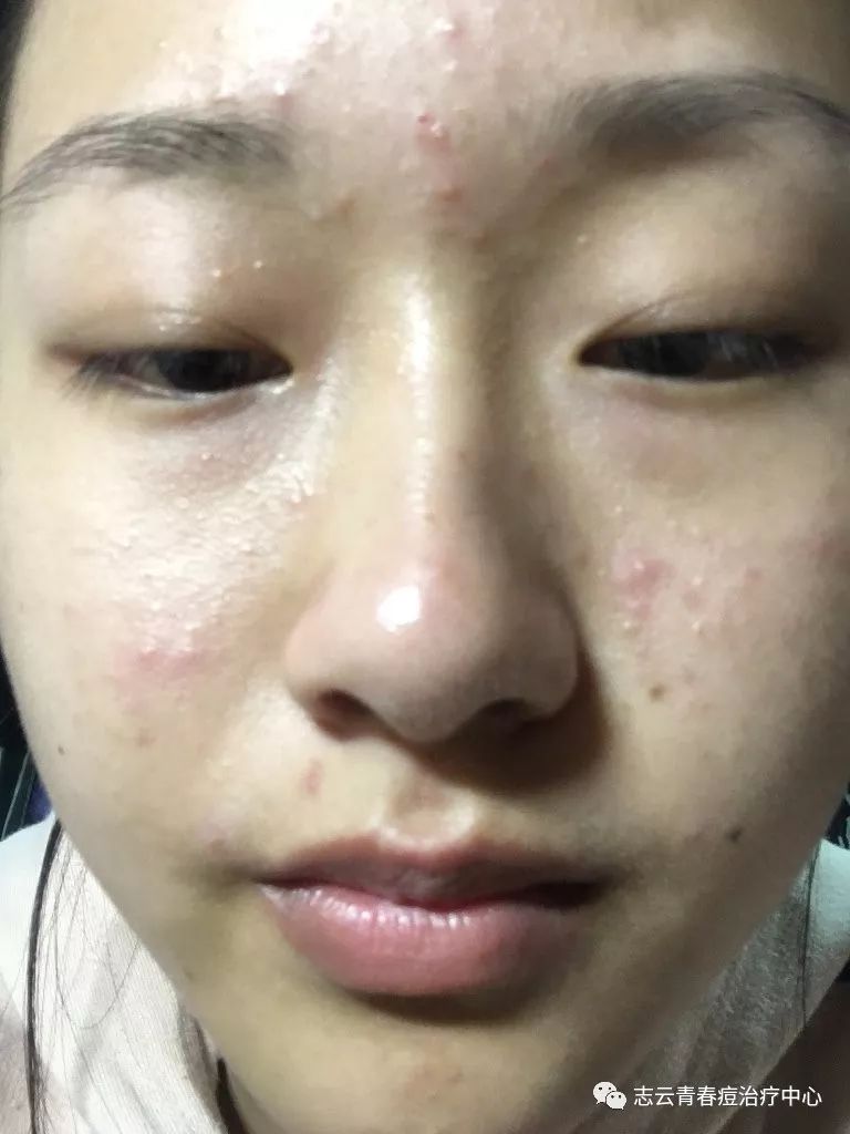 女人月经期前脸上长痘的原因是什么?