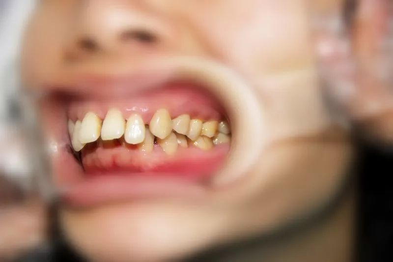 从面相学上来分析,牙缝大是漏财的象征之一,这并没有科学依据,但抛开