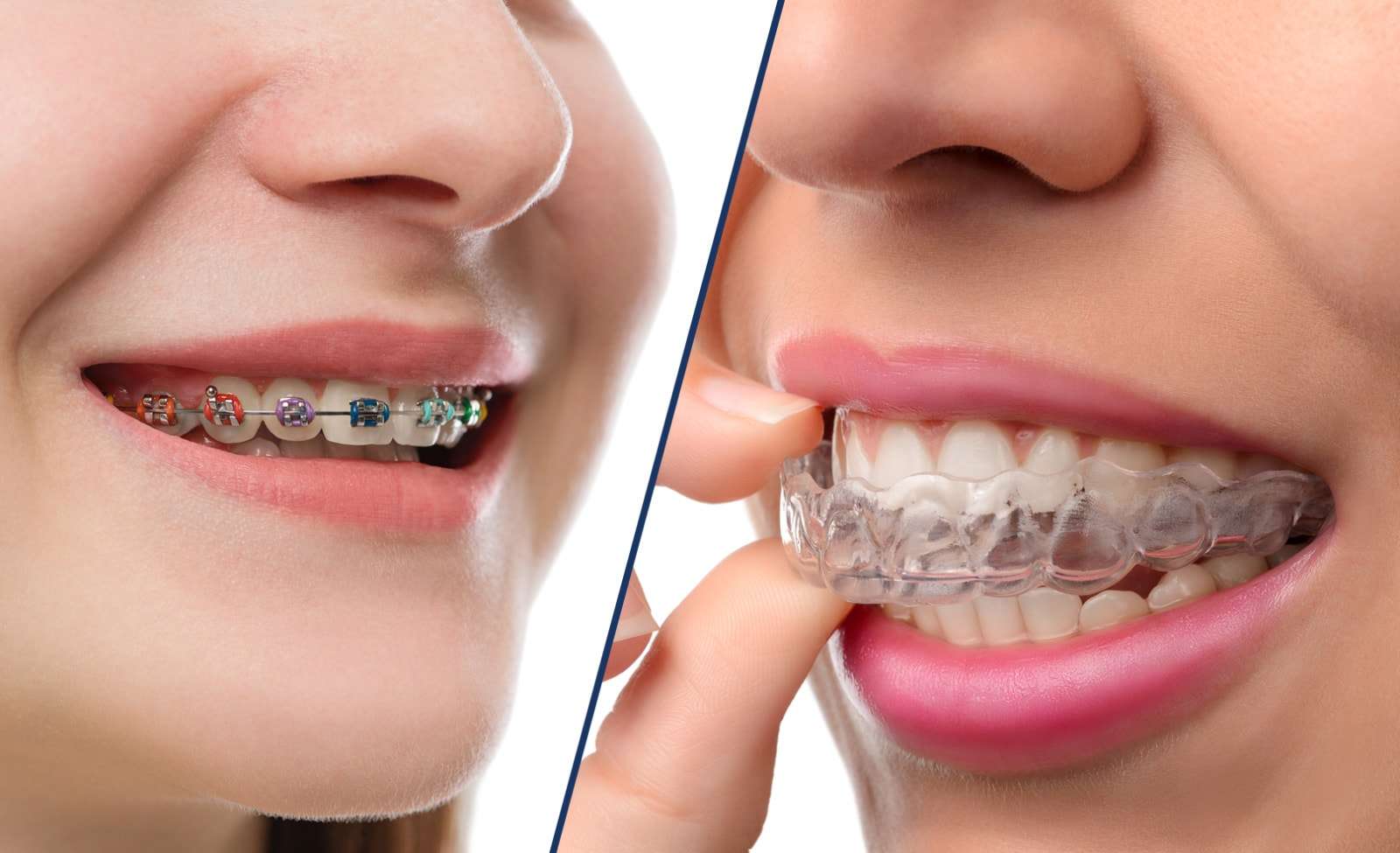 隐形牙套vs钢丝牙套,究竟哪种适合你?