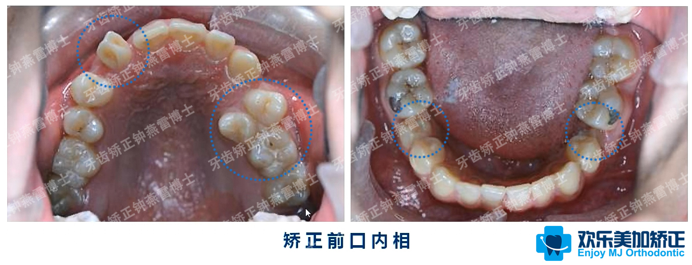 严重拥挤 埋伏阻生牙 畸形牙,拔牙是唯一的解决途径吗