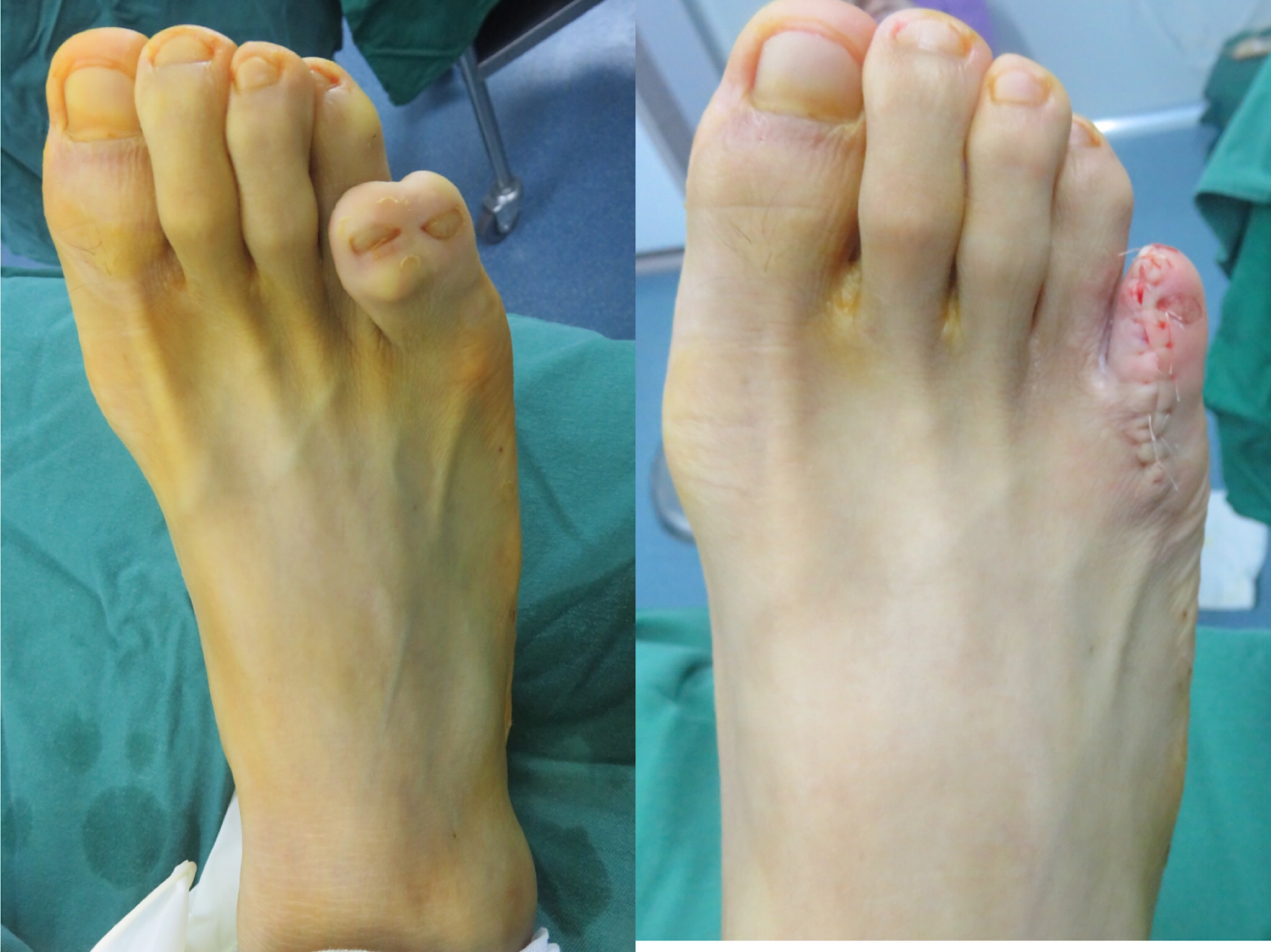 案例2:足部"多趾"     男孩,右足第5脚趾多趾,医院术前为他制定完善