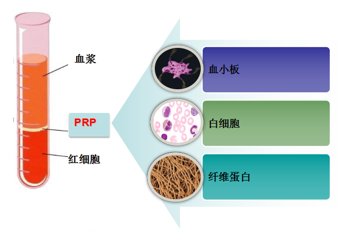 提取的prp(富血小板血浆,以喷洒或注射的方法应用于患者自身,通过