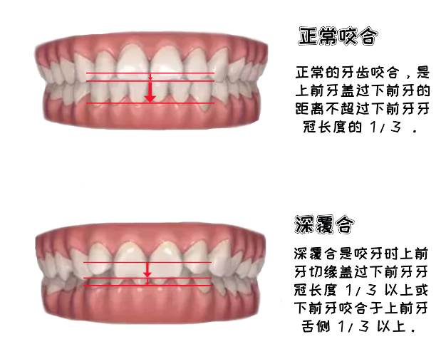 正常的牙齿咬合是上前牙盖过下前牙的距离应不超过下前牙牙冠长度的1