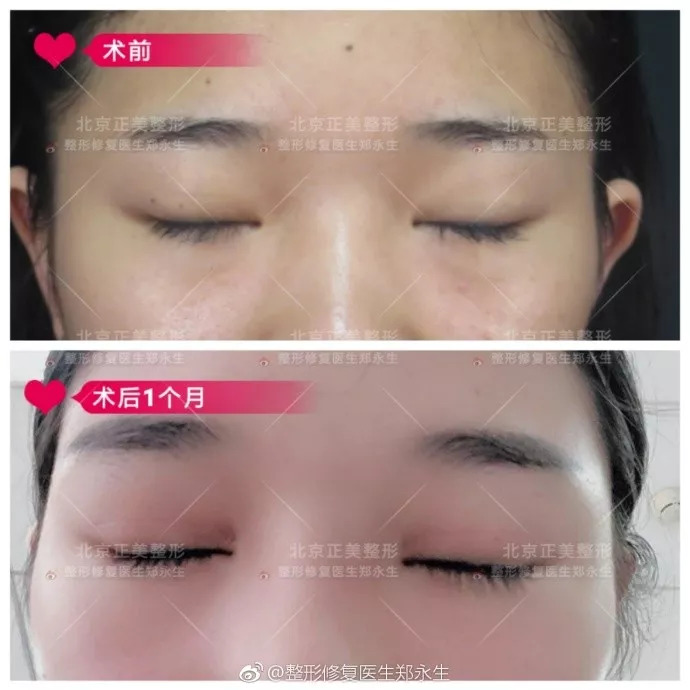 全切双眼皮两年了,闭眼痕迹明显怎么修复