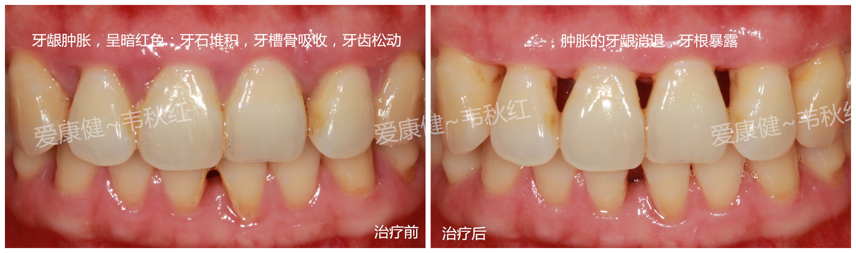 重度牙周炎治疗前后对比