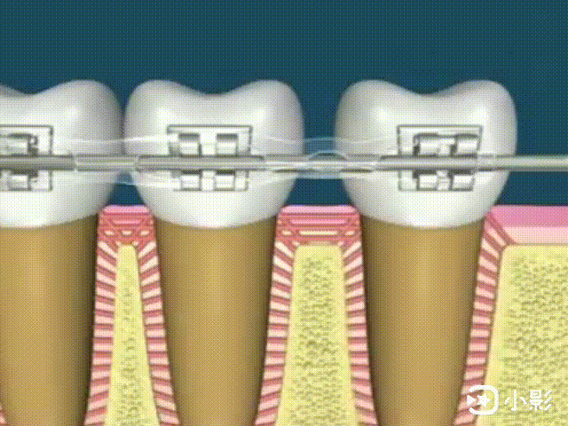 为什么有些人牙齿矫正很快,有些却慢一些?
