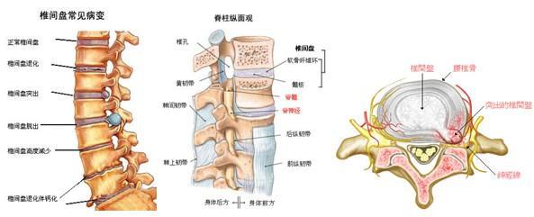 为什么"我"的腰椎间盘会突出?