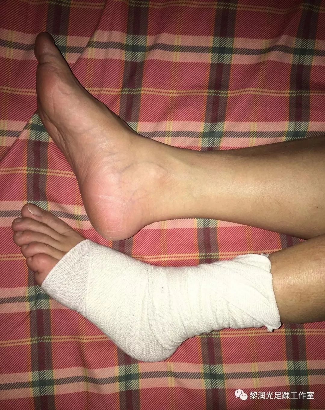 崴到脚了真难受,10个解答告诉你怎么办