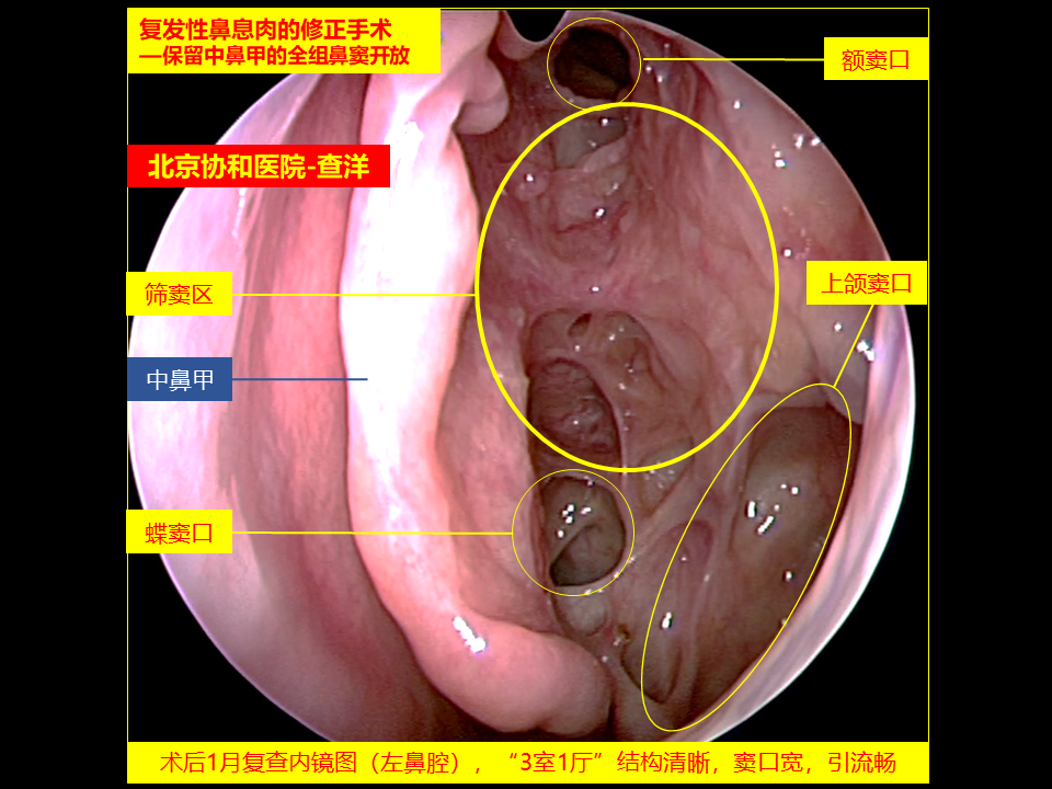鼻窦炎鼻息肉手术成功与否的判断方法
