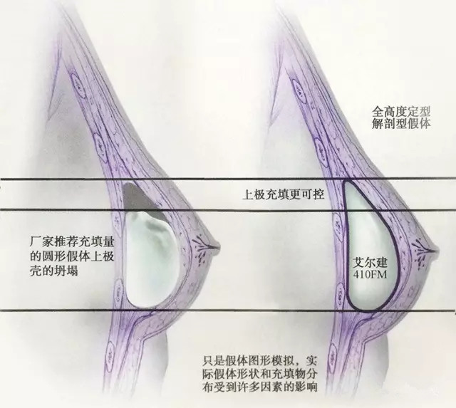 水滴形假体的优点在于它能够更好地控制填充物的主要分布和保持乳房上