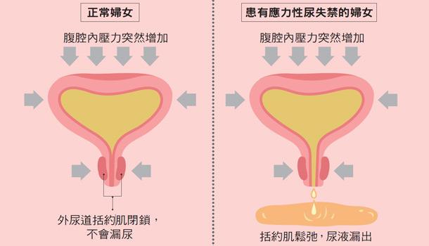 诊断鉴别诊断尿失禁都有哪些检查