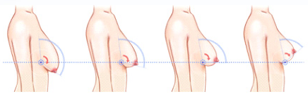 乳房下垂是指乳房因各种原因离开正常位置沿胸壁向下移位,使乳房最低