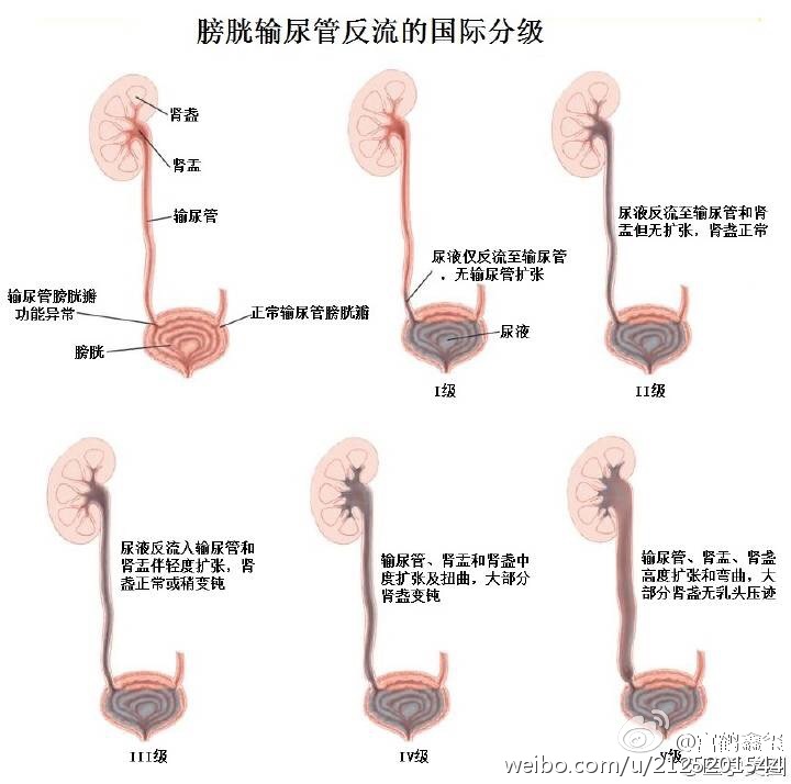 憋尿久了尿液会不会回流到肾