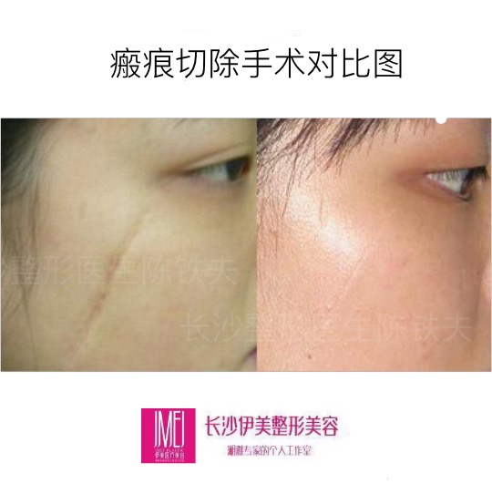 可以基本接近正常皮肤,但是疤痕切除手术效果要根据个人的体质,体质不