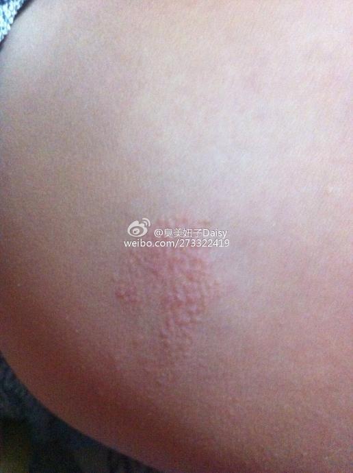 您好我女儿今年2岁半这两天屁股周围起了很多小丘疹不