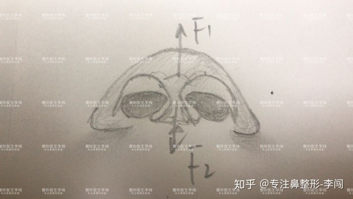但是f1的力量加强了同样它会向下让f2(大翼软骨内侧角踏板)的力量也