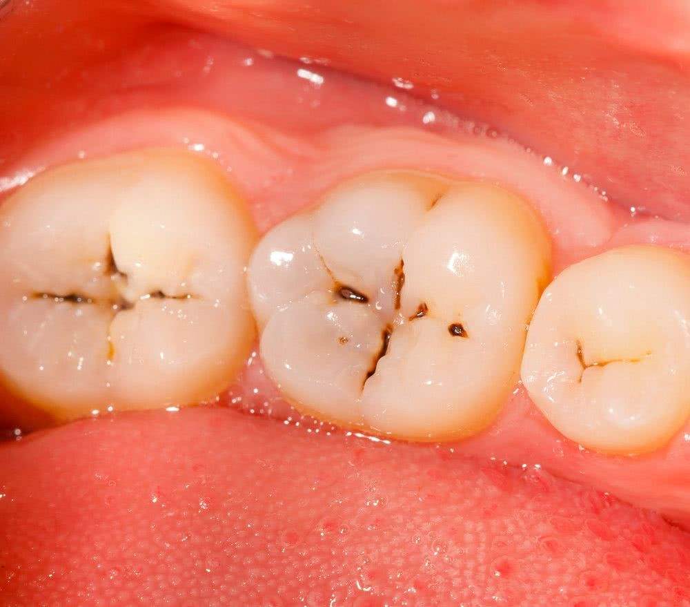 牙齿上的小黑点到底是怎么回事?