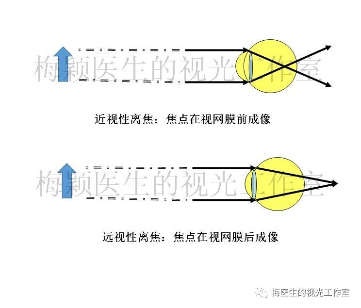 焦点在视网膜前的离焦情况叫近视性离焦;焦点在视网膜后的离焦情况叫