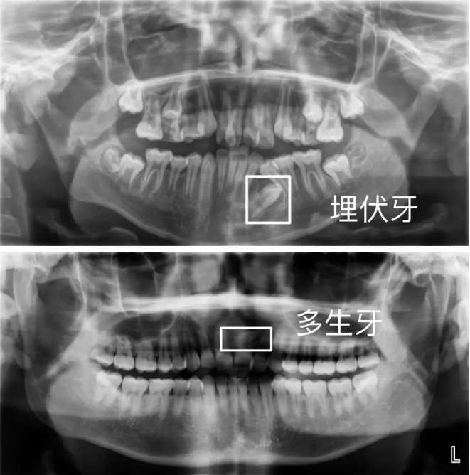 埋伏牙和多生牙,医生通常会视情况选择牵引出来或拔除掉.