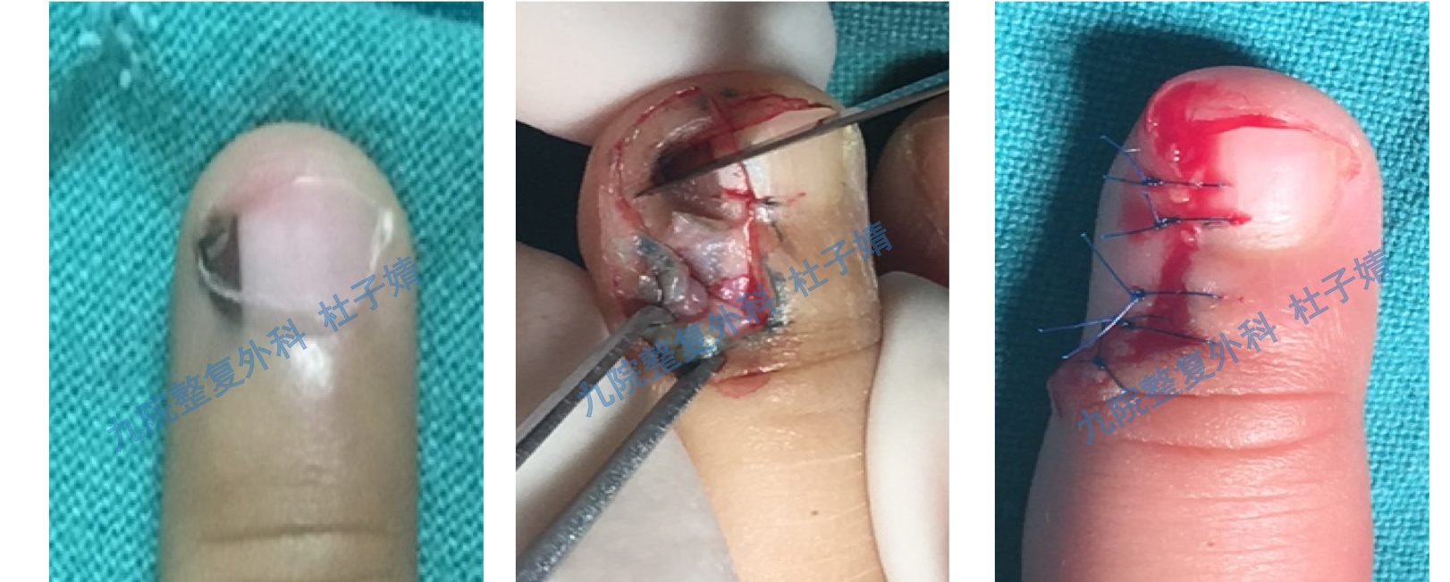 如果甲黑线位于一侧且较宽的指甲甲黑线,通常行手术切除,可将剩余