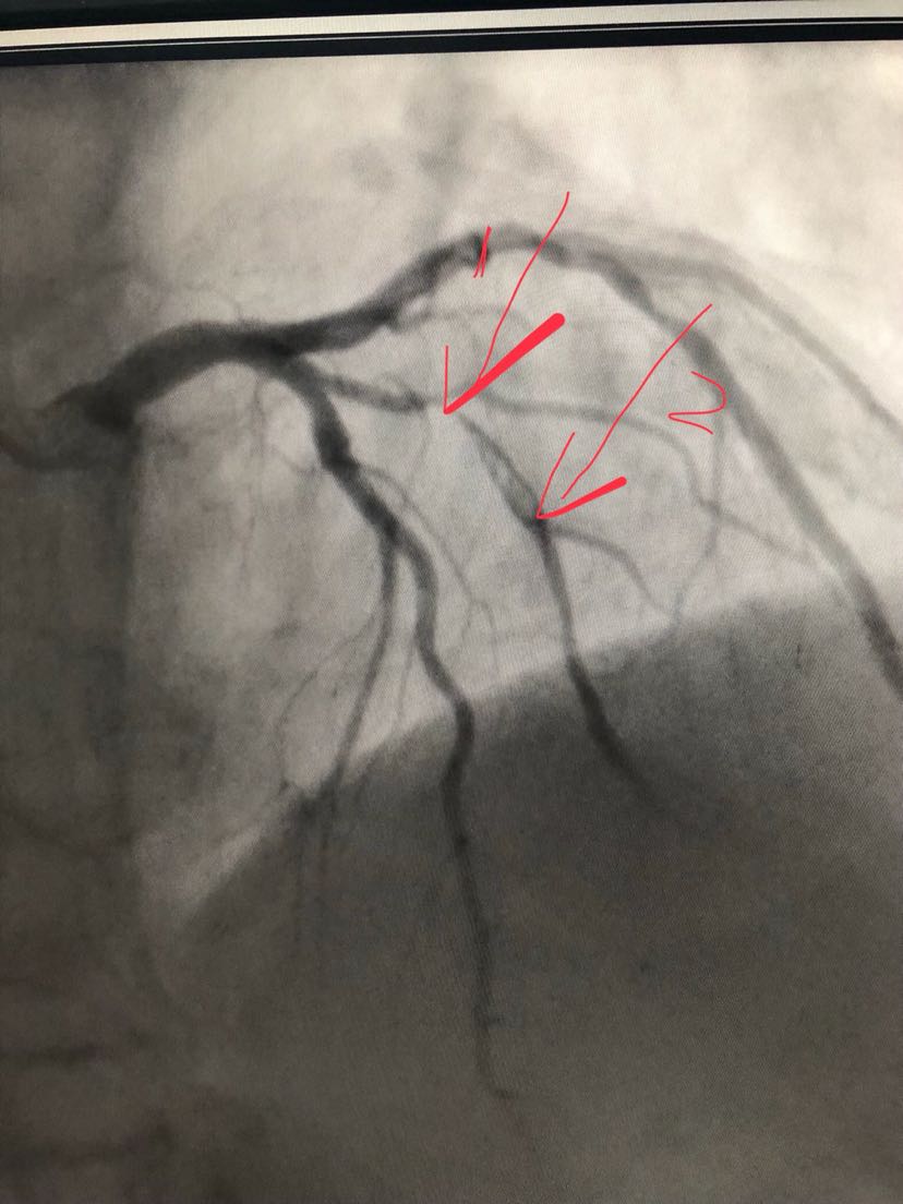 5个小时,急诊行冠状动脉造影示(图1):第一对角支近段99%狭窄(箭头1)