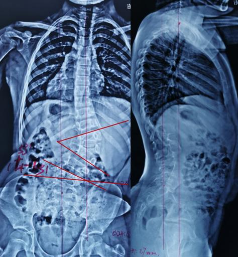 手术治疗先天性脊柱侧凸畸形 脊髓纵裂病例分享