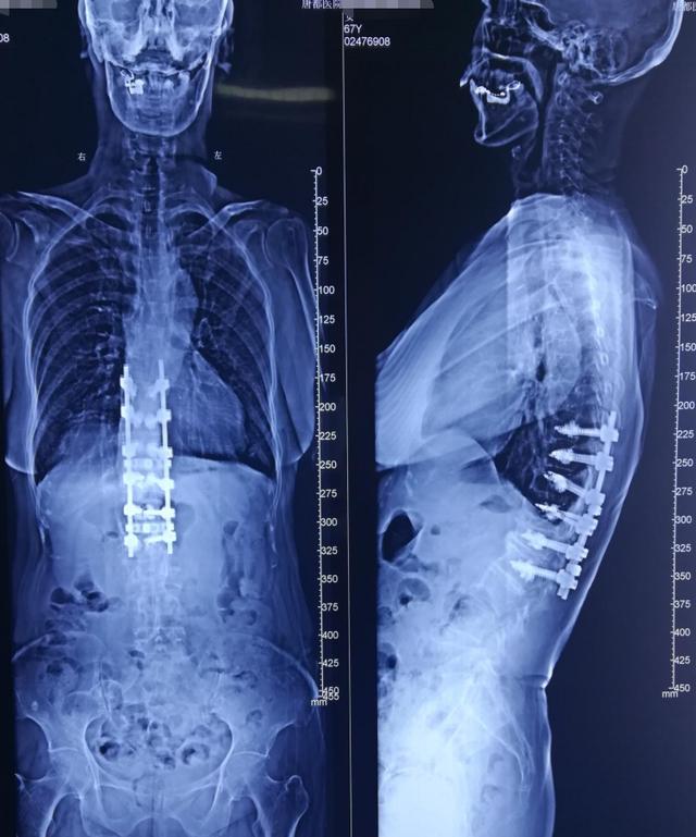 病例分享:胸腰段脊柱后凸畸形