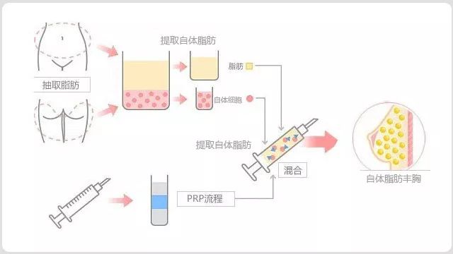 假体丰胸&自体脂肪丰胸,哪种更适合你?