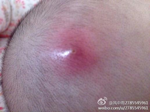 头上长脓包大全_头上长脓包图集分享